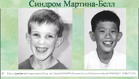 Синдром Мартина-Белл или ломкой X-хромосомы или фрагильной X-хромосомы